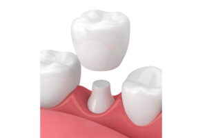 smiles plus dental implants